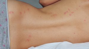 typical bed bug bites