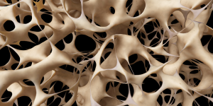 brittle bones in adults